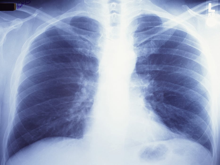 lung x-ray