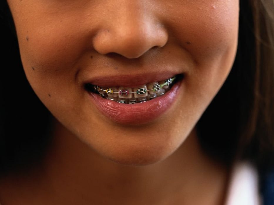 Unos Dientes Perfectos No Garantizan Una Vida Perfecta Consumer Health News Healthday