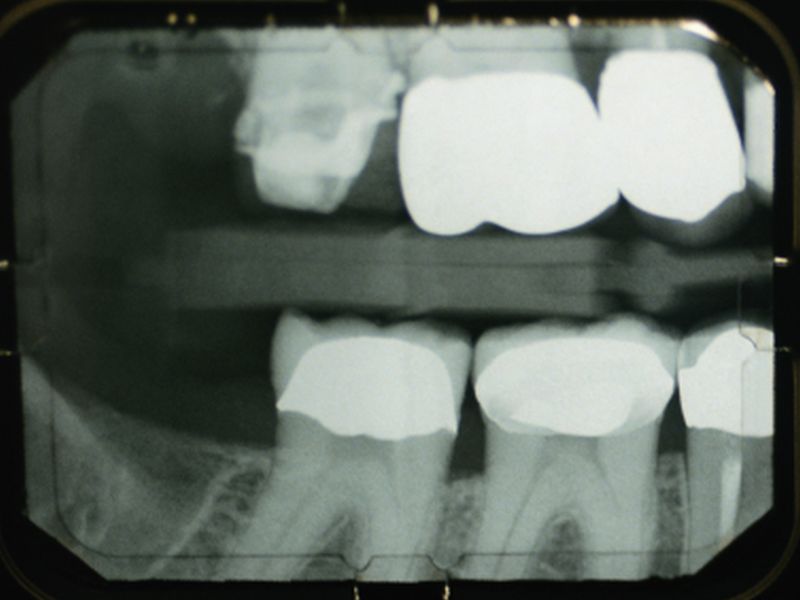 News Picture: How Long Do Teeth Survive After Root Canal?