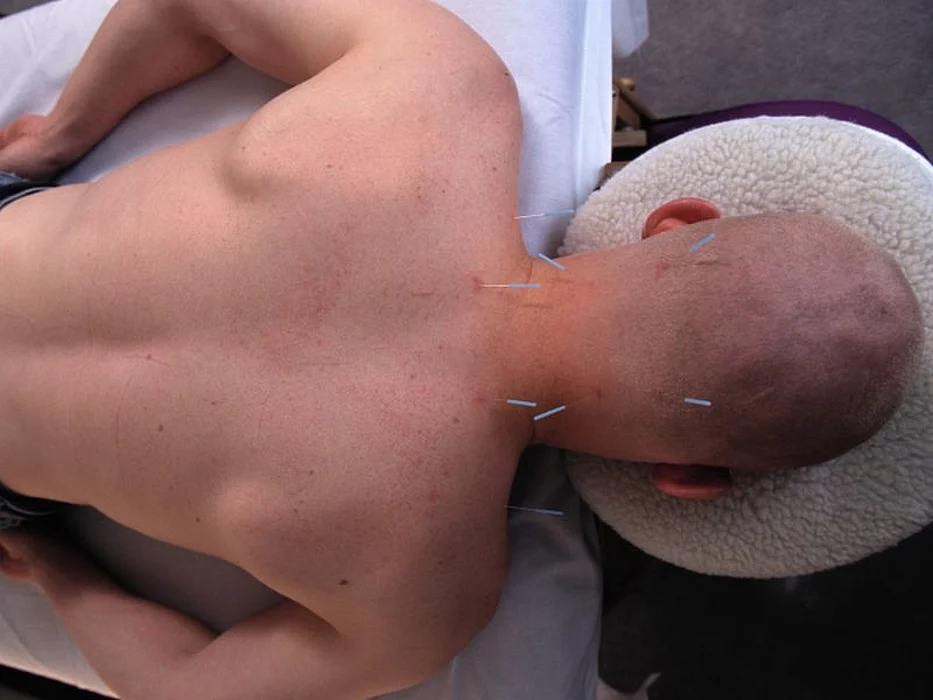 acupuncture