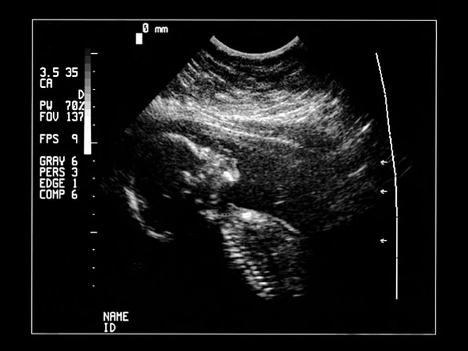 ultrasound