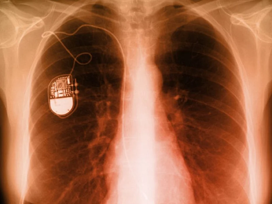chest x-ray