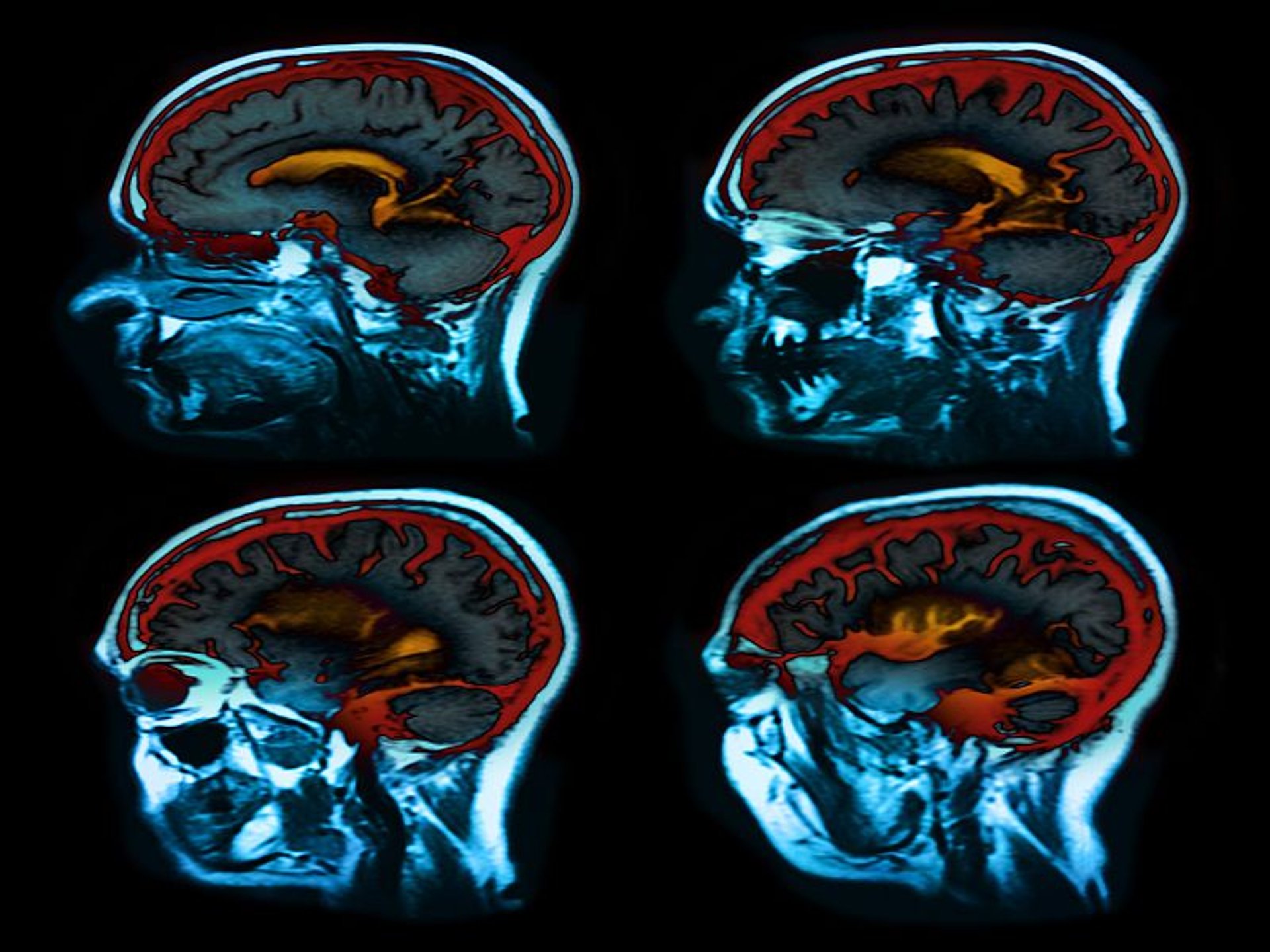 News Picture: Scans Reveal How COVID-19 Can Harm the Brain