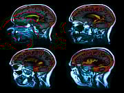 Les facteurs de risque CV et l’athérosclérose pourraient altérer le métabolisme cérébral