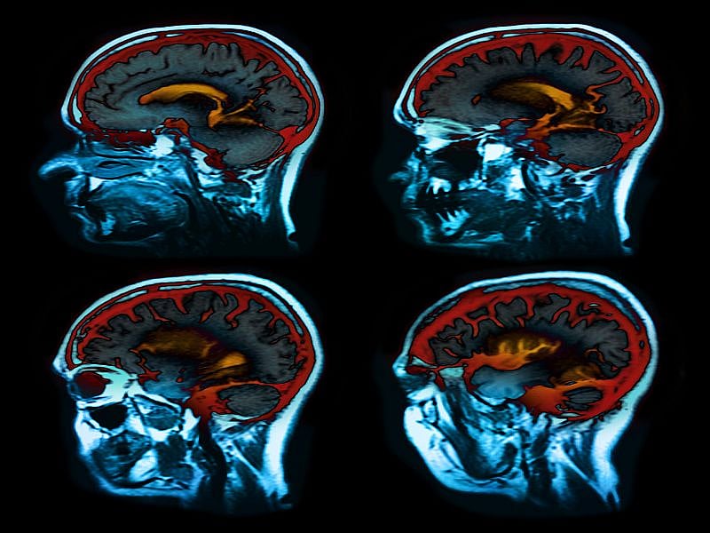 Scans Reveal How COVID-19 Can Harm the Brain