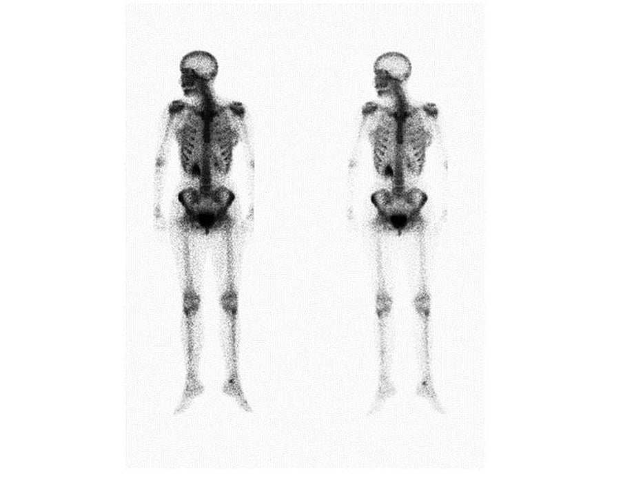 skeletons