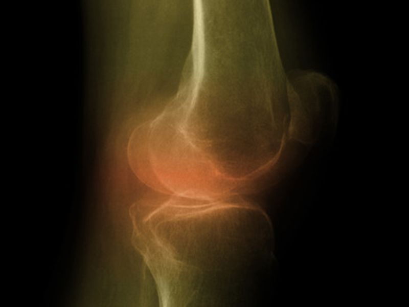 News Picture: Knee Replacement in Folks Over 80: Less Risky Than You Think