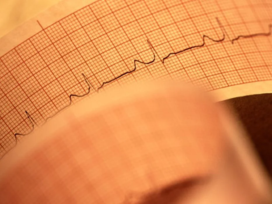EKG printout