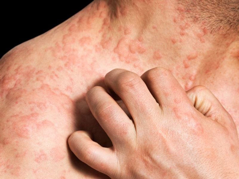 Research Finds Contagious Staph in LupusRelated Skin