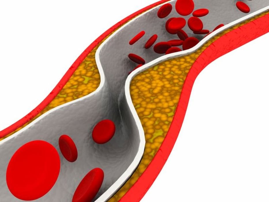 plaque in artery