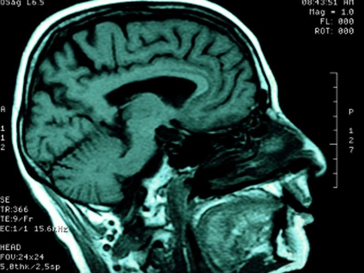 News Picture: Is There a 'Risk-Taking' Center in the Brain?