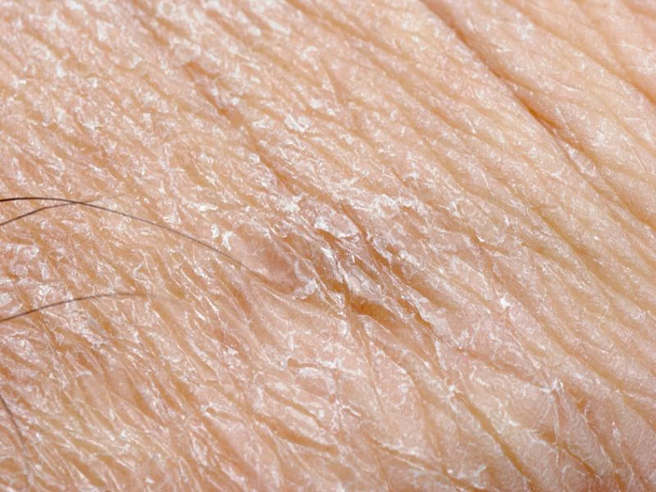 eczema