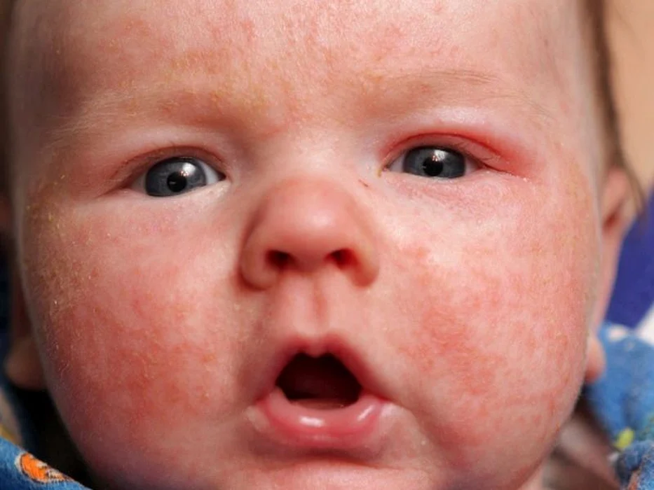 baby with eczema