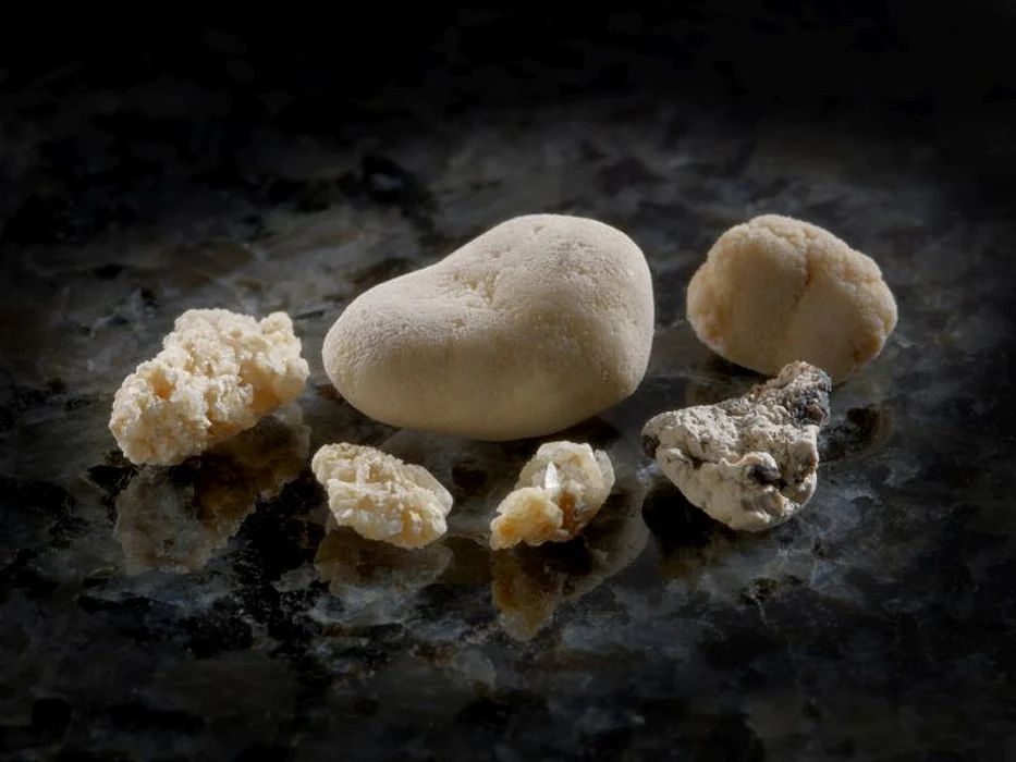 kidney stones