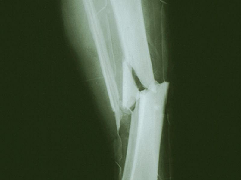 News Picture: Early Trial Offers Hope Treating Rare 'Brittle Bone' Disease