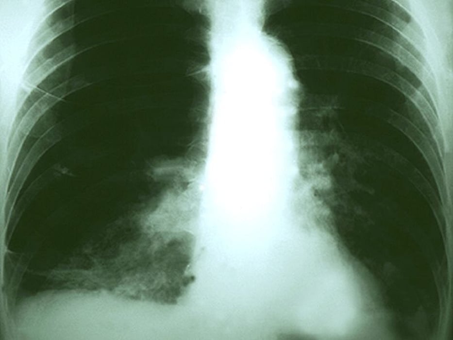cancer xray