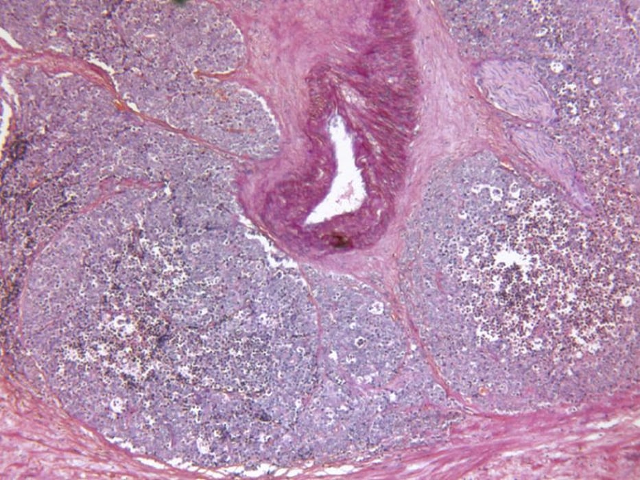 prostate cancer