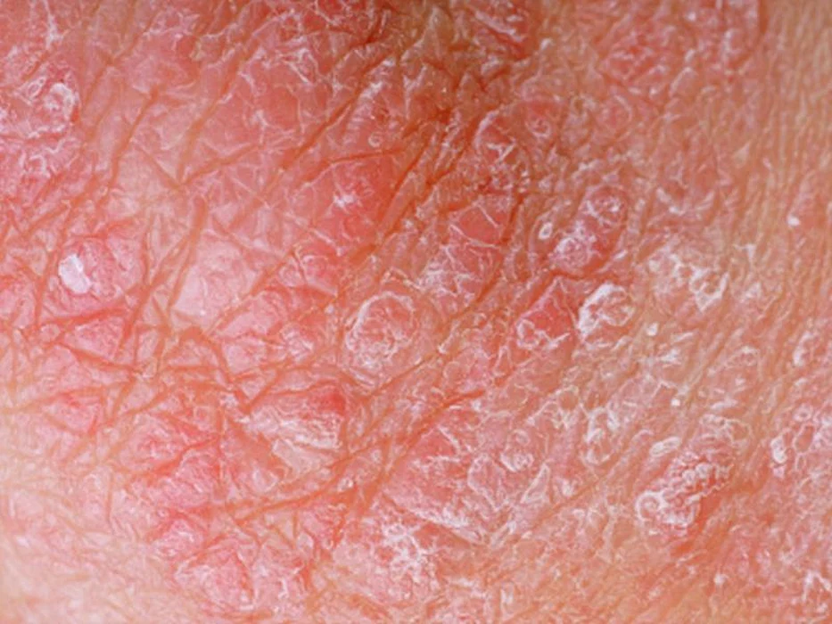psoriasis