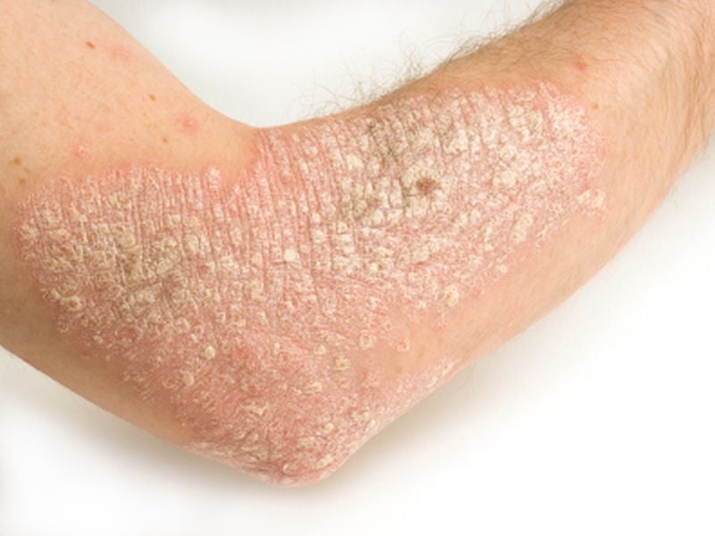 Heart Risk Factors May Be Especially Unhealthy in People With Psoriasis