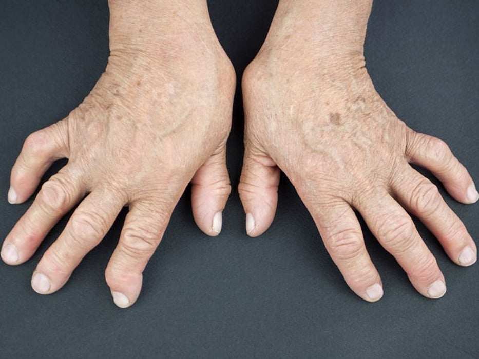 arthritic hands
