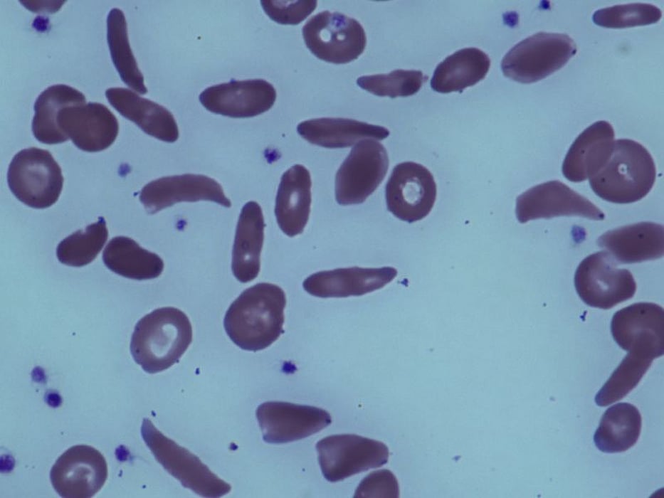 sickle cell anemia