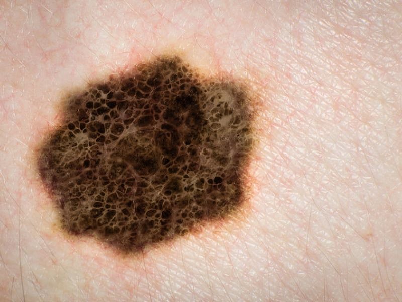 ai better than docs at catching skin cancers consumer health news healthday