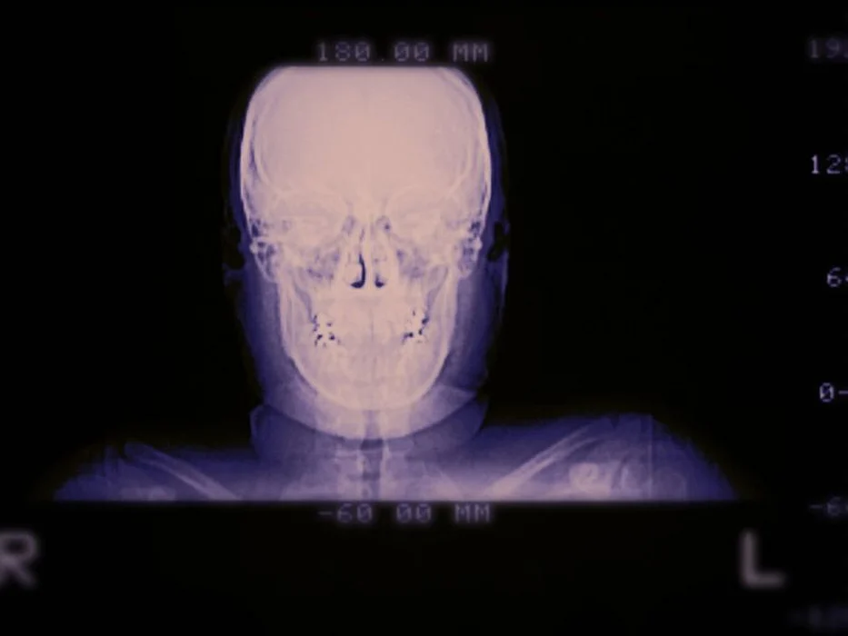 skull