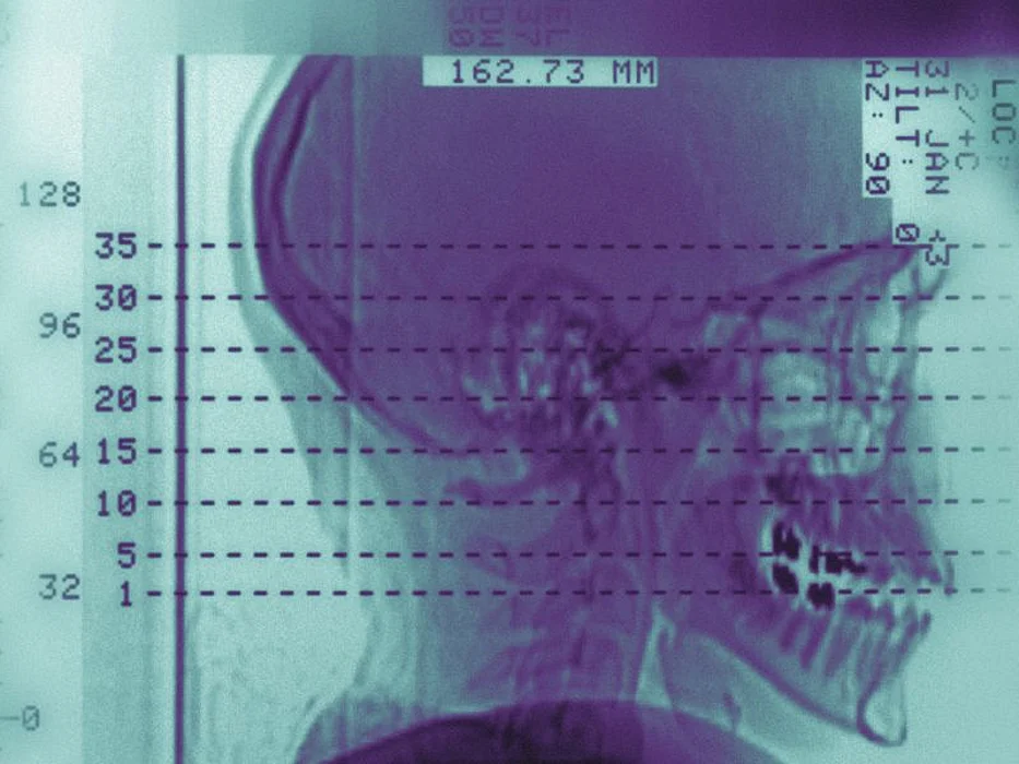 skull