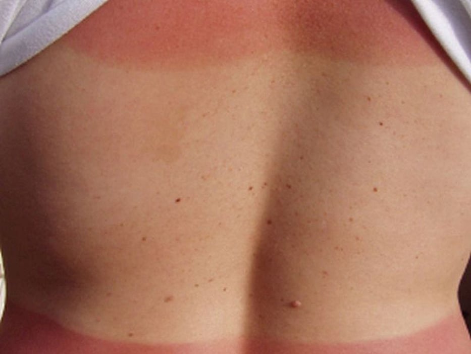 sunburn