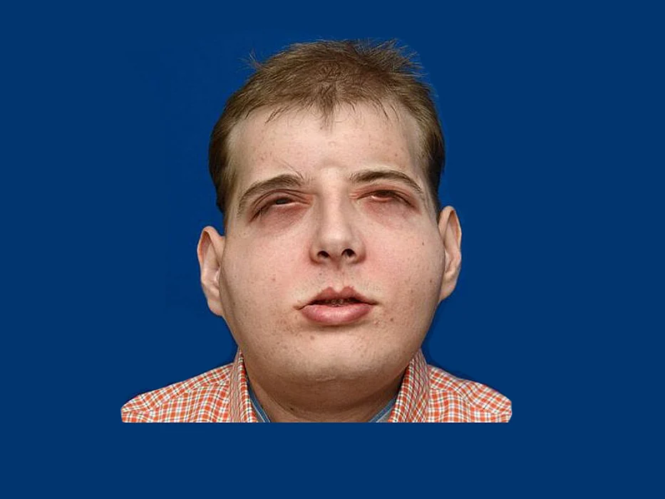 face transplant