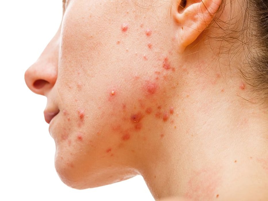 teen with acne