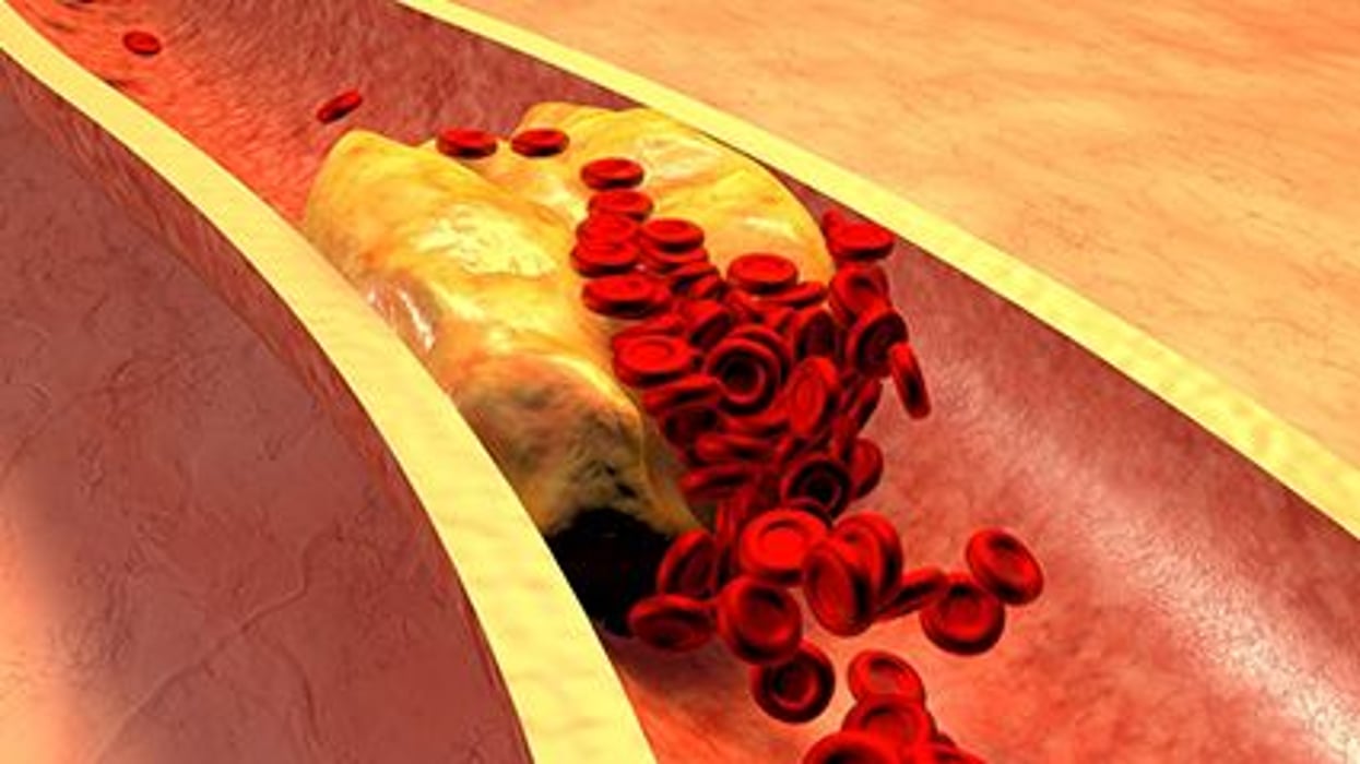 Cholesterol Dangers