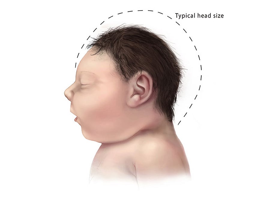 microcephaly