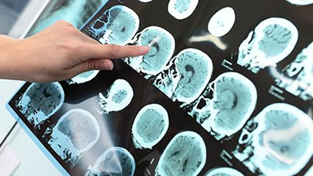 exercise and dementia