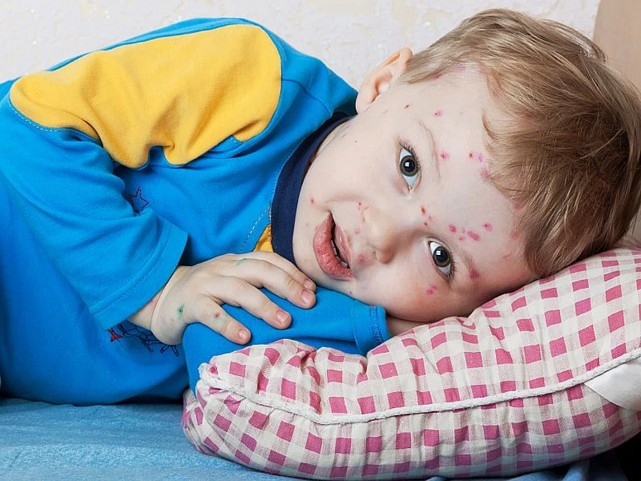 boy with chickenpox