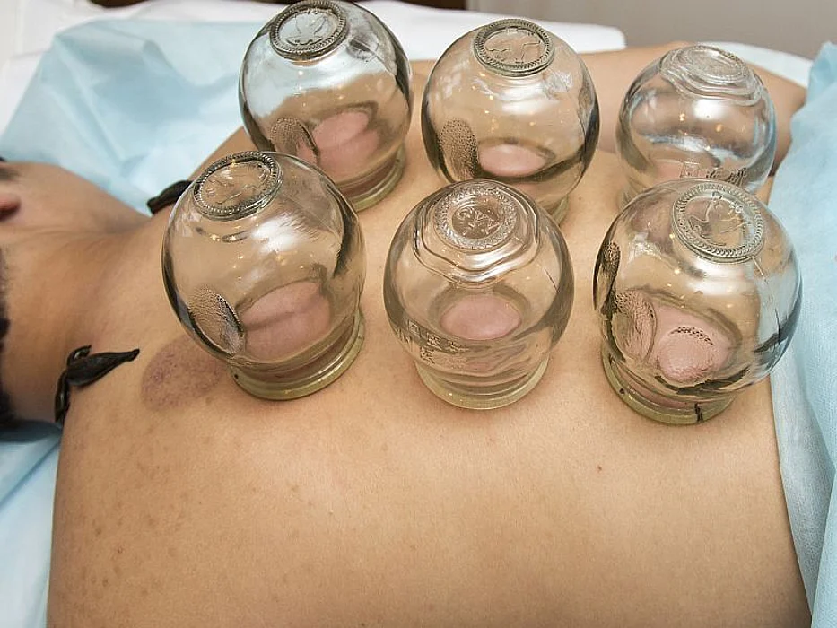 cupping therapy