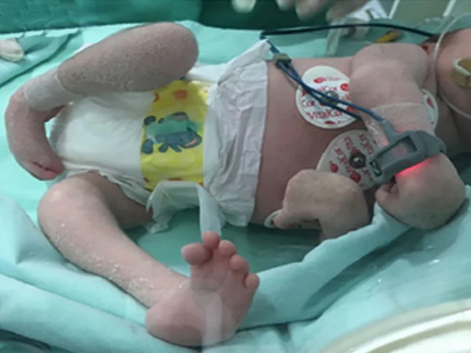 arthrogryposis