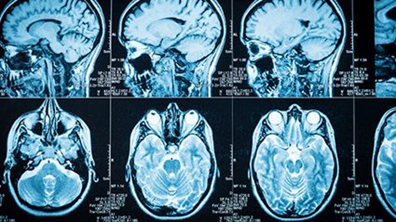Special Brain Scans May Diagnose Early Parkinson's