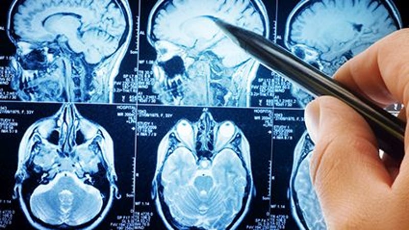 Neurologists Much Tougher to Find in Rural America