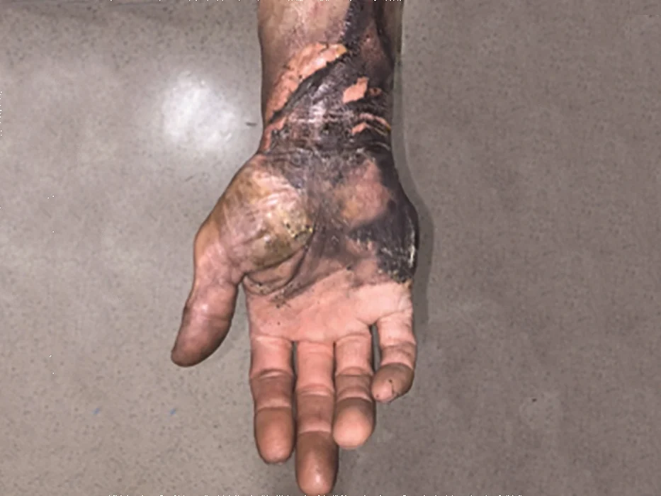 ecigarette burn