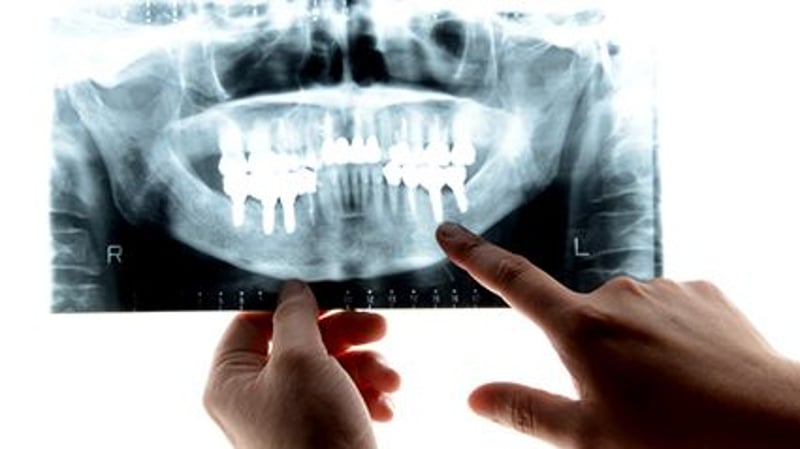 How Gum Disease Could Raise Your Odds for Severe COVID-19