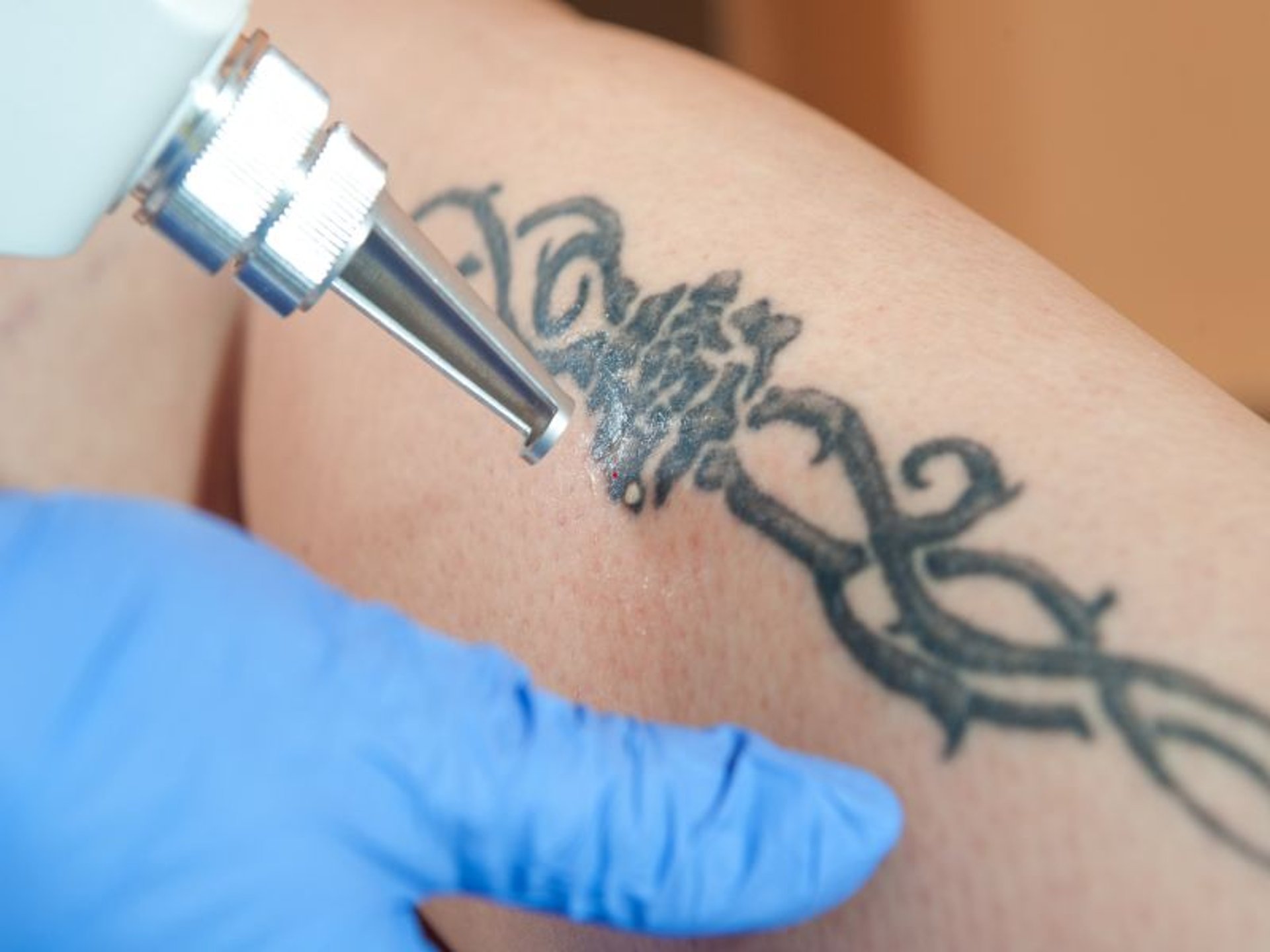 News Picture: Tattoo Regret? Here's Tips on Safely Getting Old 'Ink' Removed
