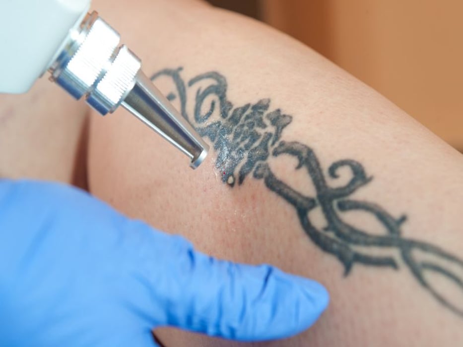 Bad Reaction From a New Tattoo? Here's What to Do - Consumer Health News |  HealthDay