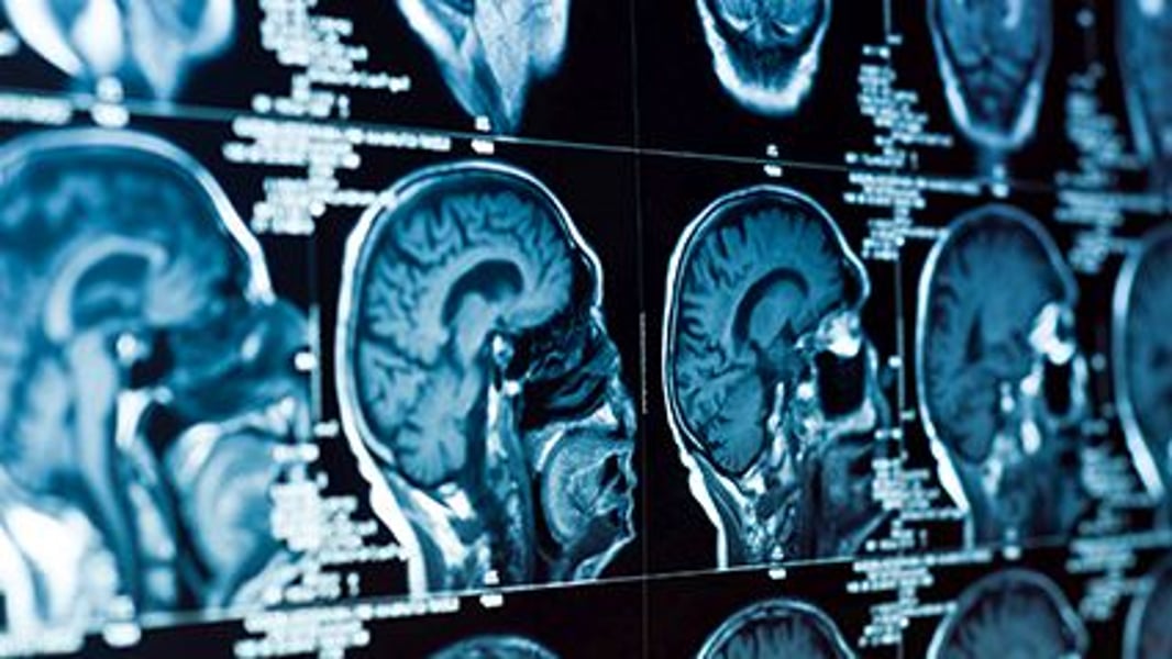 Fluid-Filled Spaces in the Brain Linked to Worsening Memory - HealthDay News