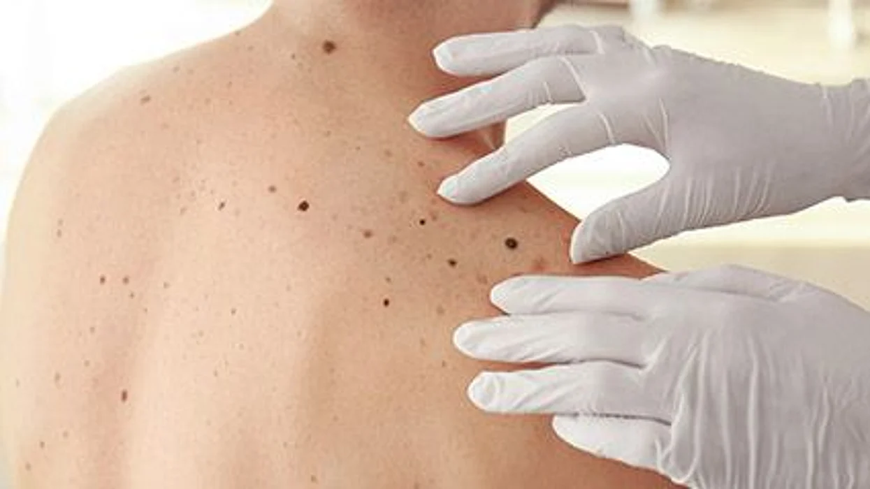 skin moles