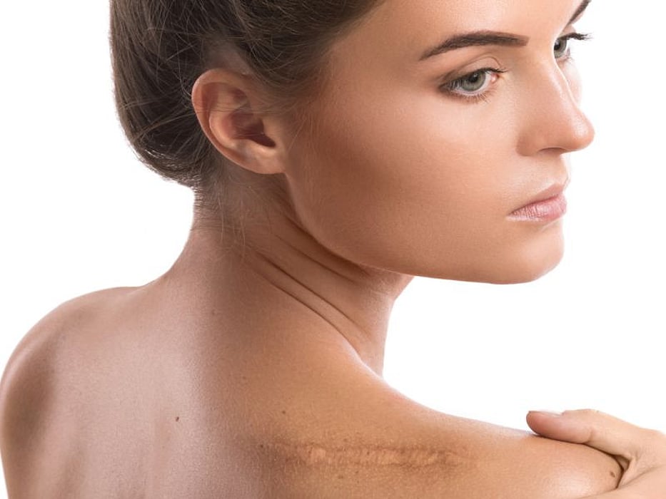 scar
