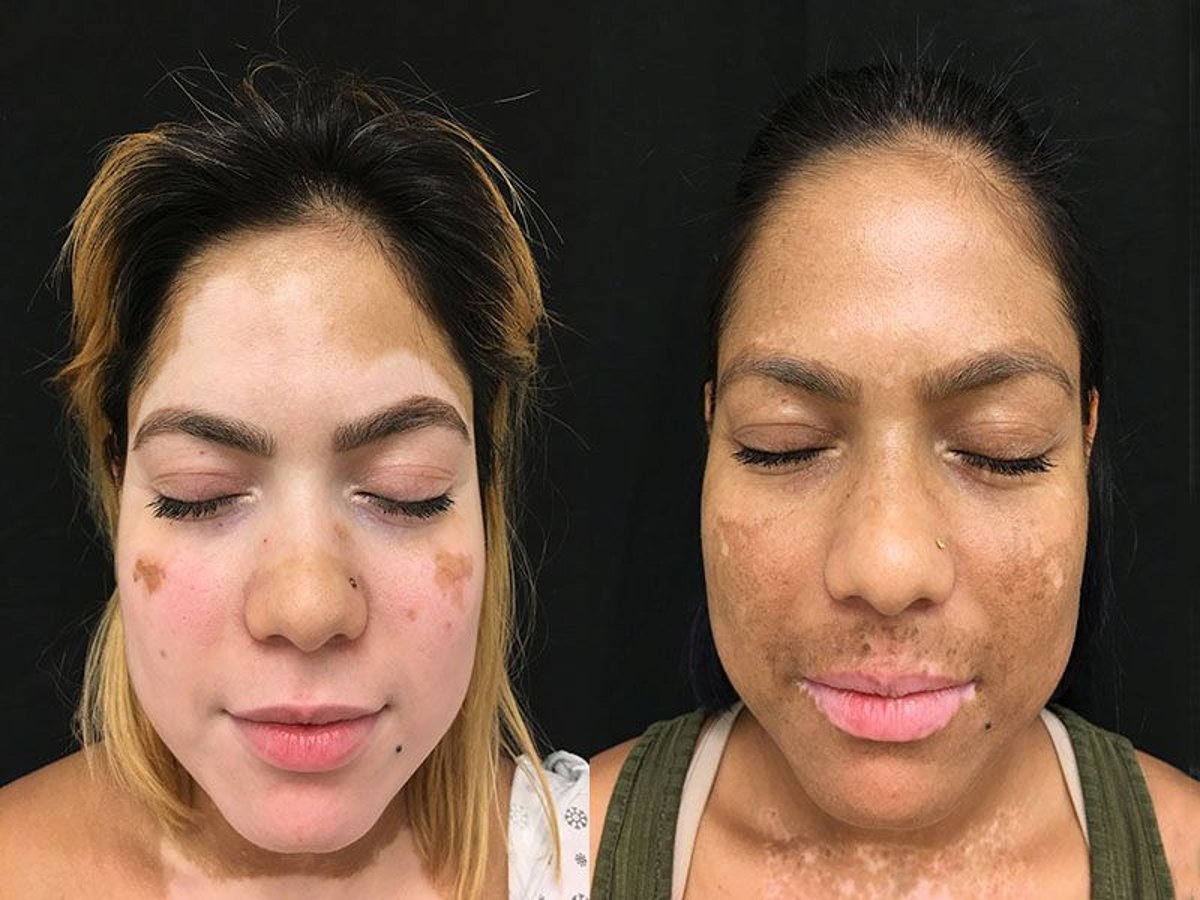 light treatment for vitiligo