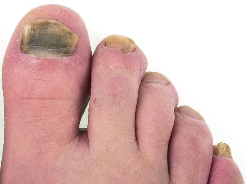 Foot Fungus on the Run … But Race Has a Long Way to Go - Consumer