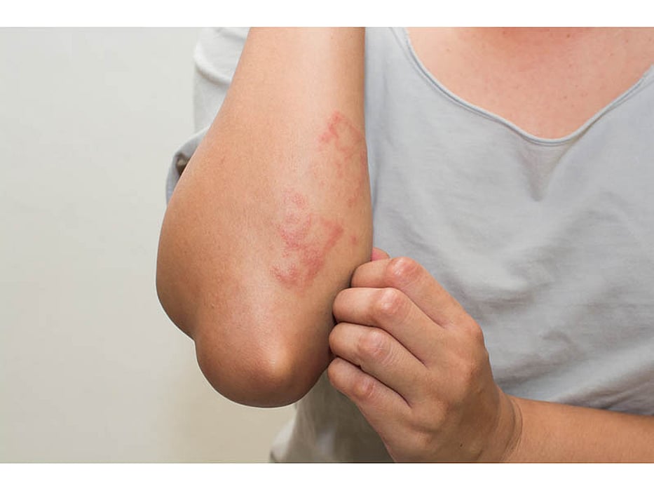 eczema autoimmune