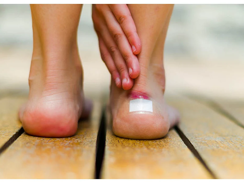 feet with a blister from the shoes